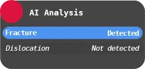 RB Fracture AI Analysis screenshot