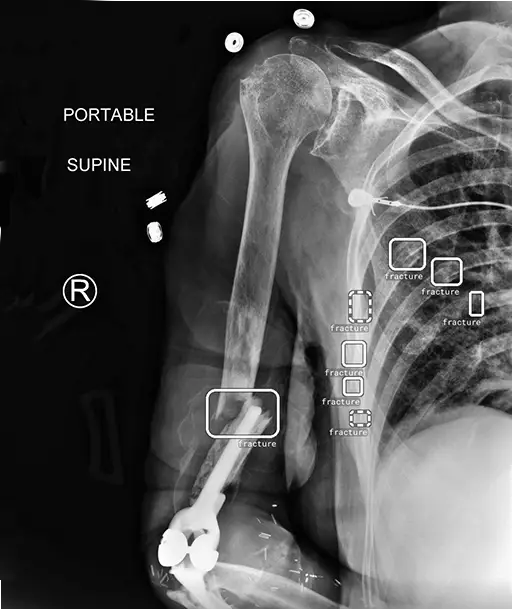 RB Fracture screenshot