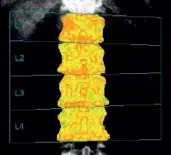 TBS Osteo - Spine heatmap